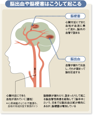 脳出血や脳梗塞はこうして起こる