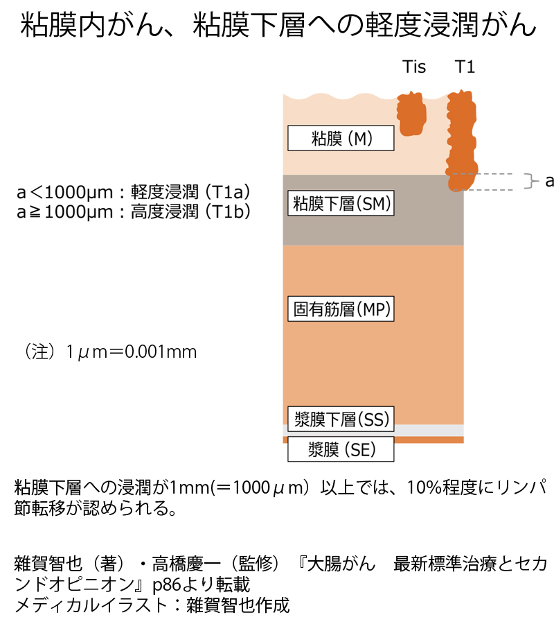 がん診断の結果は病理医によってなぜ変わるのか 大腸がん 雜賀智也 高橋慶一 ダイヤモンド オンライン