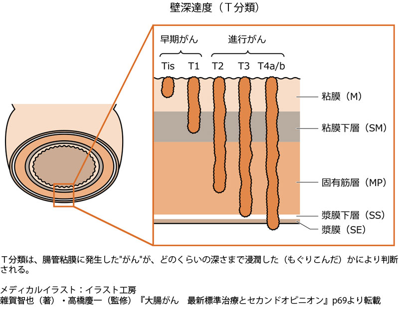 大腸がん「発見時期」で分かれる明暗、ステージ1なら5年生存率90％超 