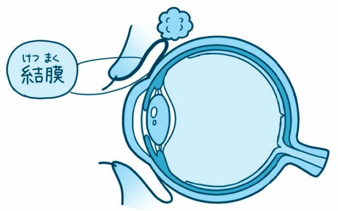 放っておくと怖い目の症状 目に大きな虫が入っていた ハーバード スタンフォードの眼科医が教える 放っておくと怖い目の症状25 ダイヤモンド オンライン