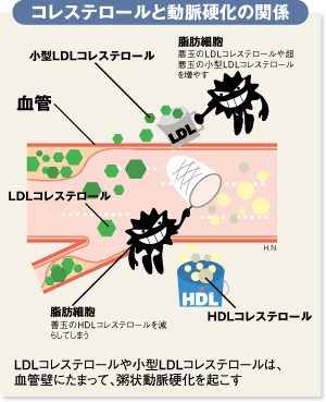 コレステロールと動脈硬化の関係