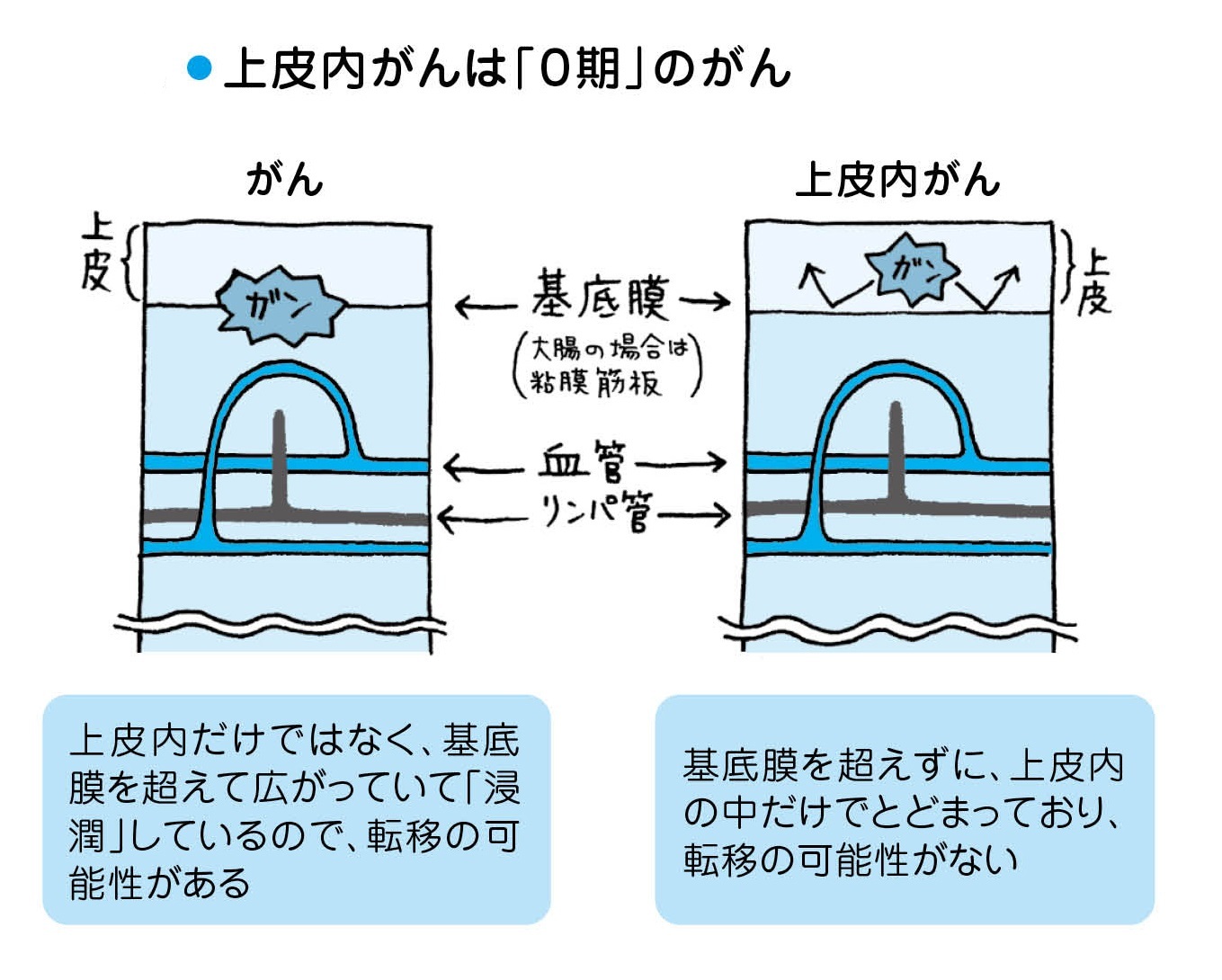 上皮 内 新 生物 と は