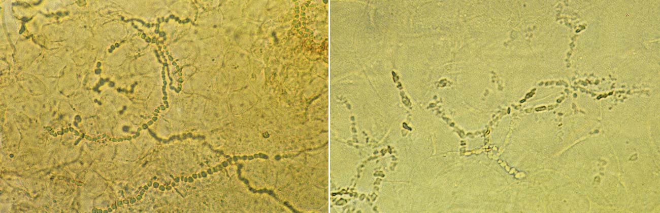 水虫 は侮れない 恐ろしい感染ルート 誤診で重症化するニセ水虫 健康 ダイヤモンド オンライン