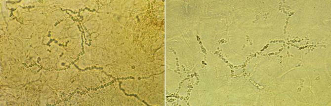 水虫 は侮れない 恐ろしい感染ルート 誤診で重症化するニセ水虫 News Amp Analysis ダイヤモンド オンライン