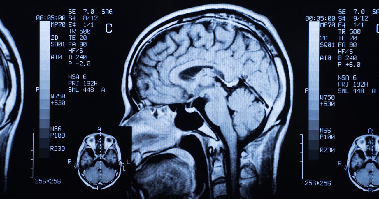 ステロイド薬の長期間使用で「脳の構造が変化」の可能性、研究結果の